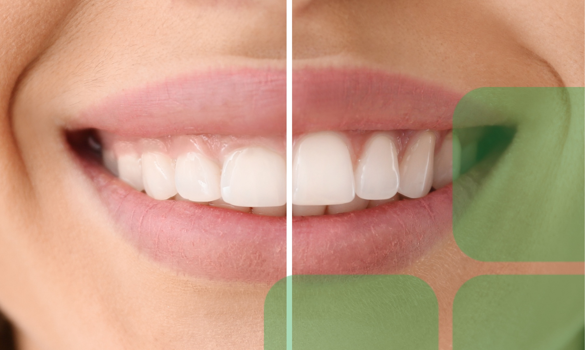 Get the smile you want with gum contouring.