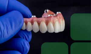 Get your smile back with All-on-X implants.